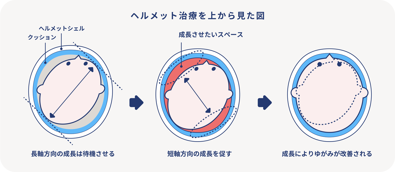ヘルメット治療を上から見た図：長軸方向の成長は待機させ、短軸方向の成長を促し、成長によりゆがみが改善される