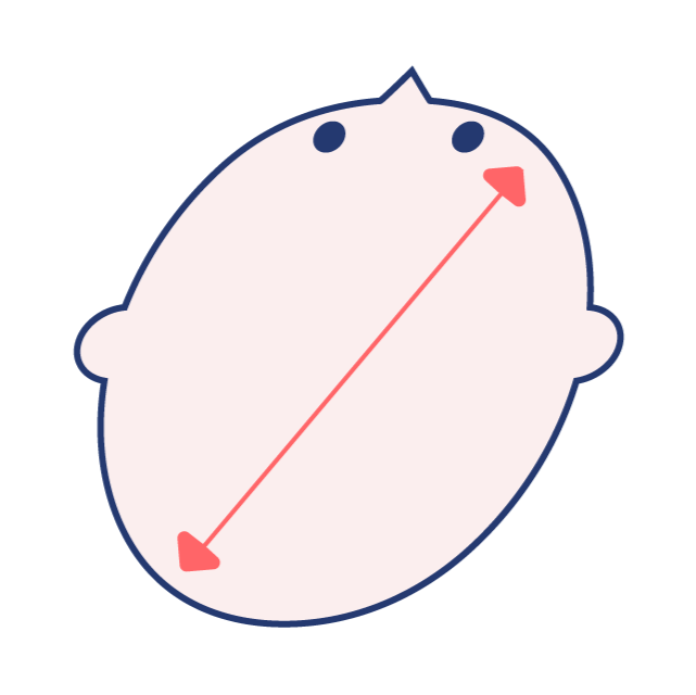 斜頭症の図